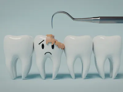 虫歯治療のイメージ