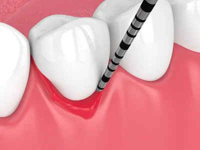 歯周病治療のイメージ