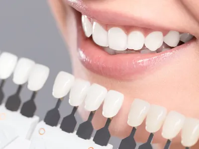 ホワイトニングのイメージ